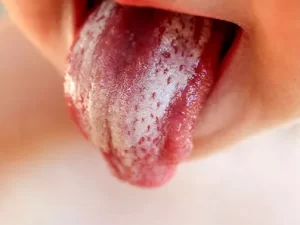 برفک دهان نوزاد