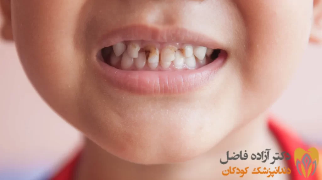 جلوگیری از پوسیدگی دندان در کودکان