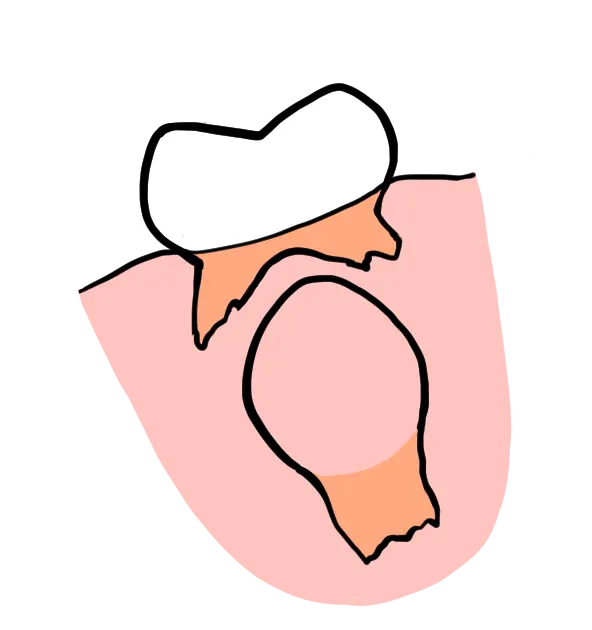 دیر افتادن دندان شیری