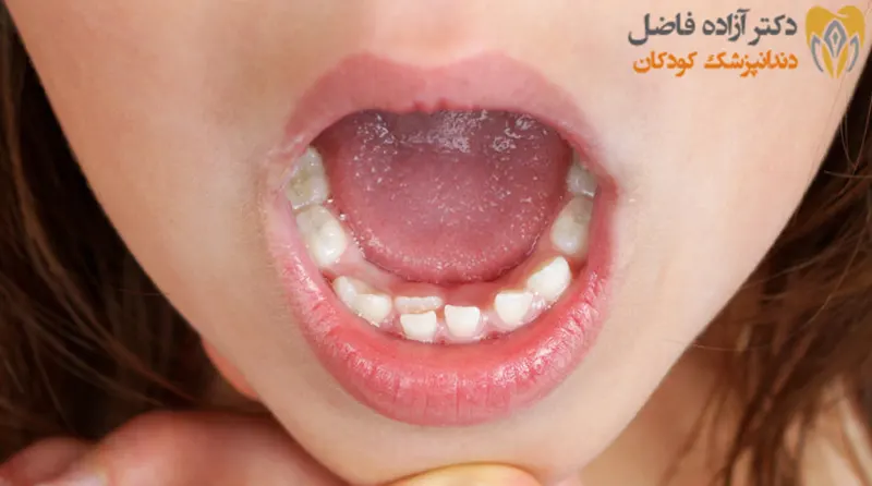 شناخت آنکیلوز دندان شیری
