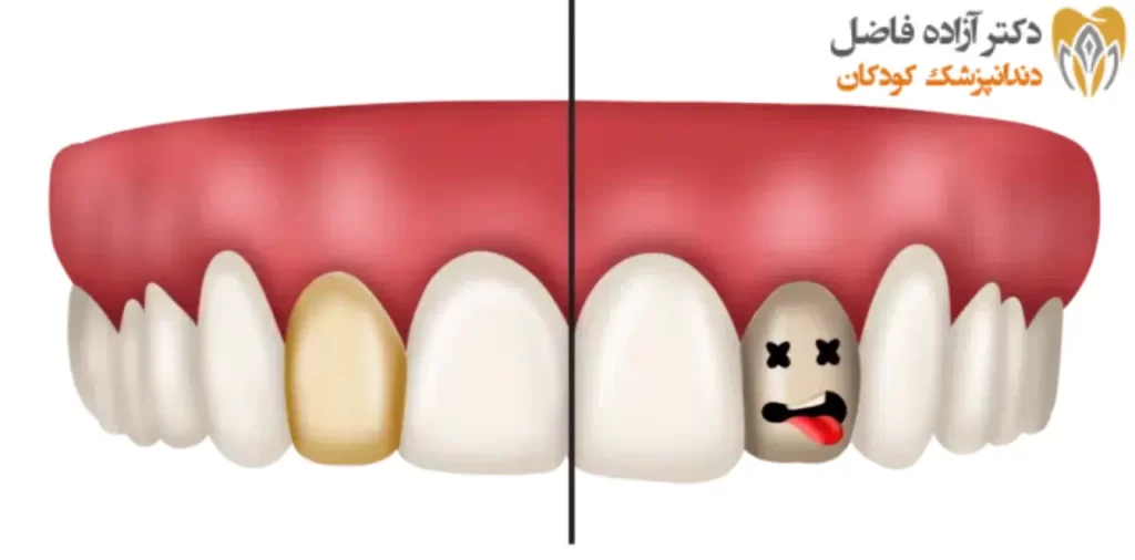 علت دندان مرده