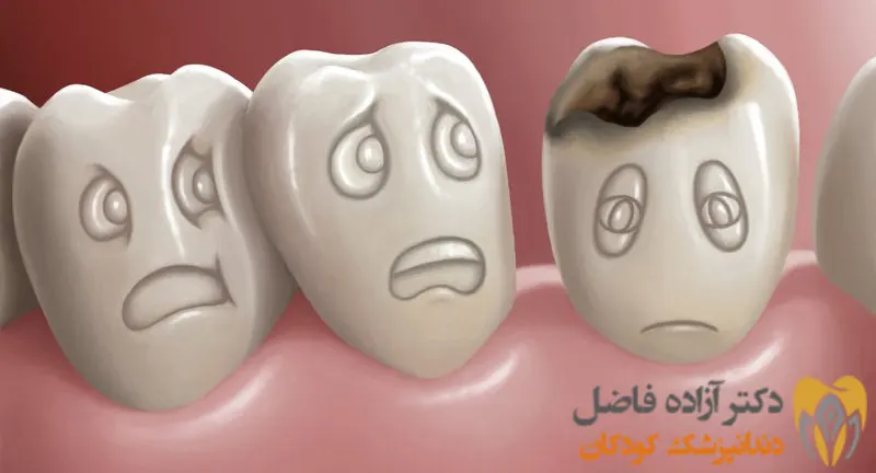 اثر قطره آهن بر پوسیدگی دندان کودکان