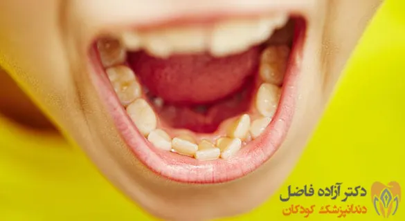 راه حل هایی برای دندان های شیری کج