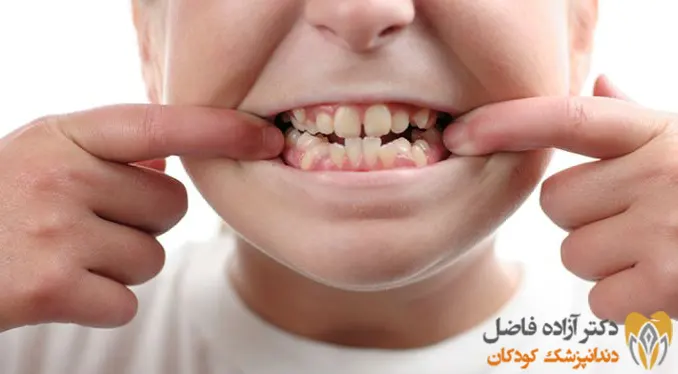 علت کج شدن دندان های شیری کودکان