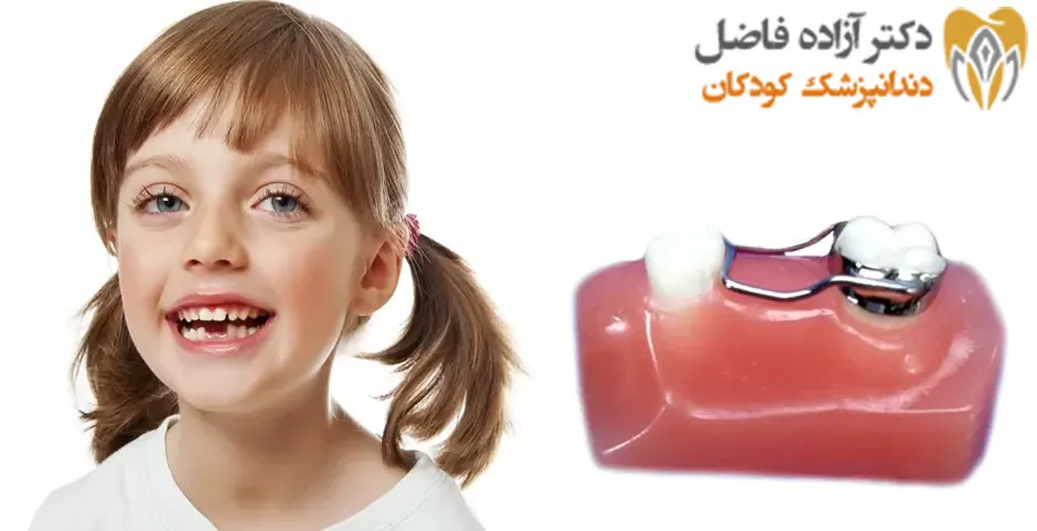 فضا نگهدارنده دندان کودکان