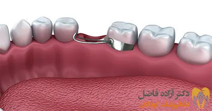 مراقبت های لازم برای دستگاه های فضا نگهدارنده