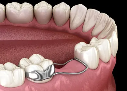 نحوه عملکرد دستگاه فضا نگهدار