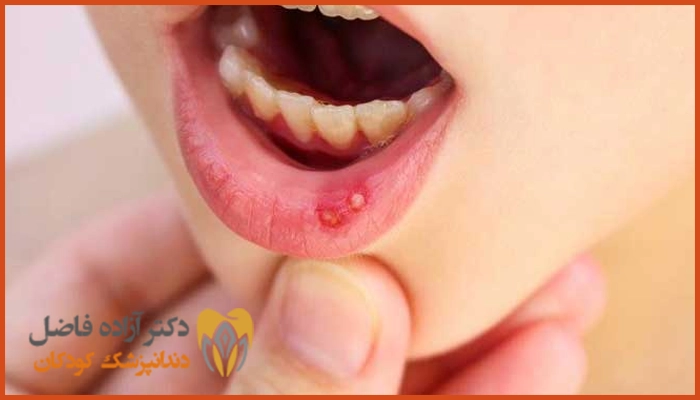 تشخیص تبخال دهان در کودکان