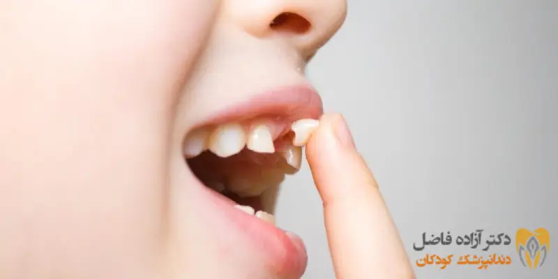 لق شدن دندان دائمی کودکان لق شدن دندان دائمی کودکان