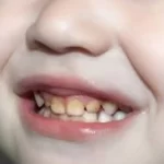8 علت زردی دندان کودکان