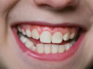 روش‌های درمانی برای کج درآمدن دندان دائمی کودکان چیست؟