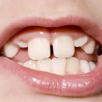 چه زمانی دندان‌های دائمی در کودکان شروع به رشد می‌کنند؟