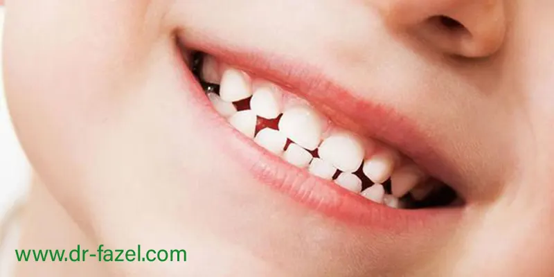 کج درآمدن دندان دائمی کودک کج درآمدن دندان دائمی کودک