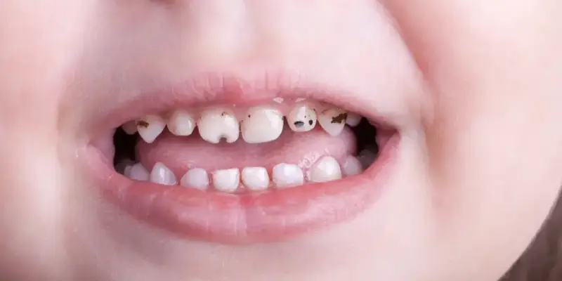 علت پوسیدگی زودرس دندان کودک چیست؟ علت پوسیدگی زودرس دندان کودک چیست؟