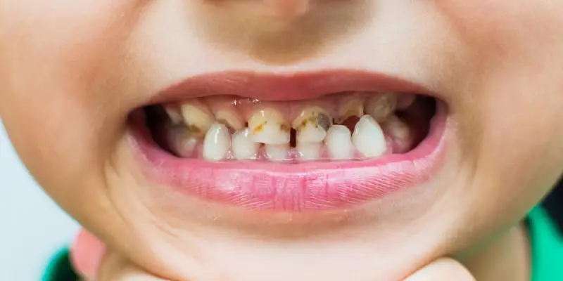 علت پوسیدگی زودرس دندان کودک چیست؟ علت پوسیدگی زودرس دندان کودک چیست؟