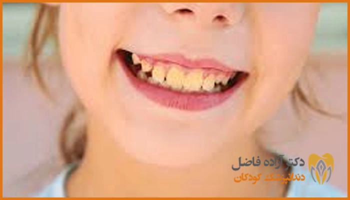 علت زردی دندان کودکان